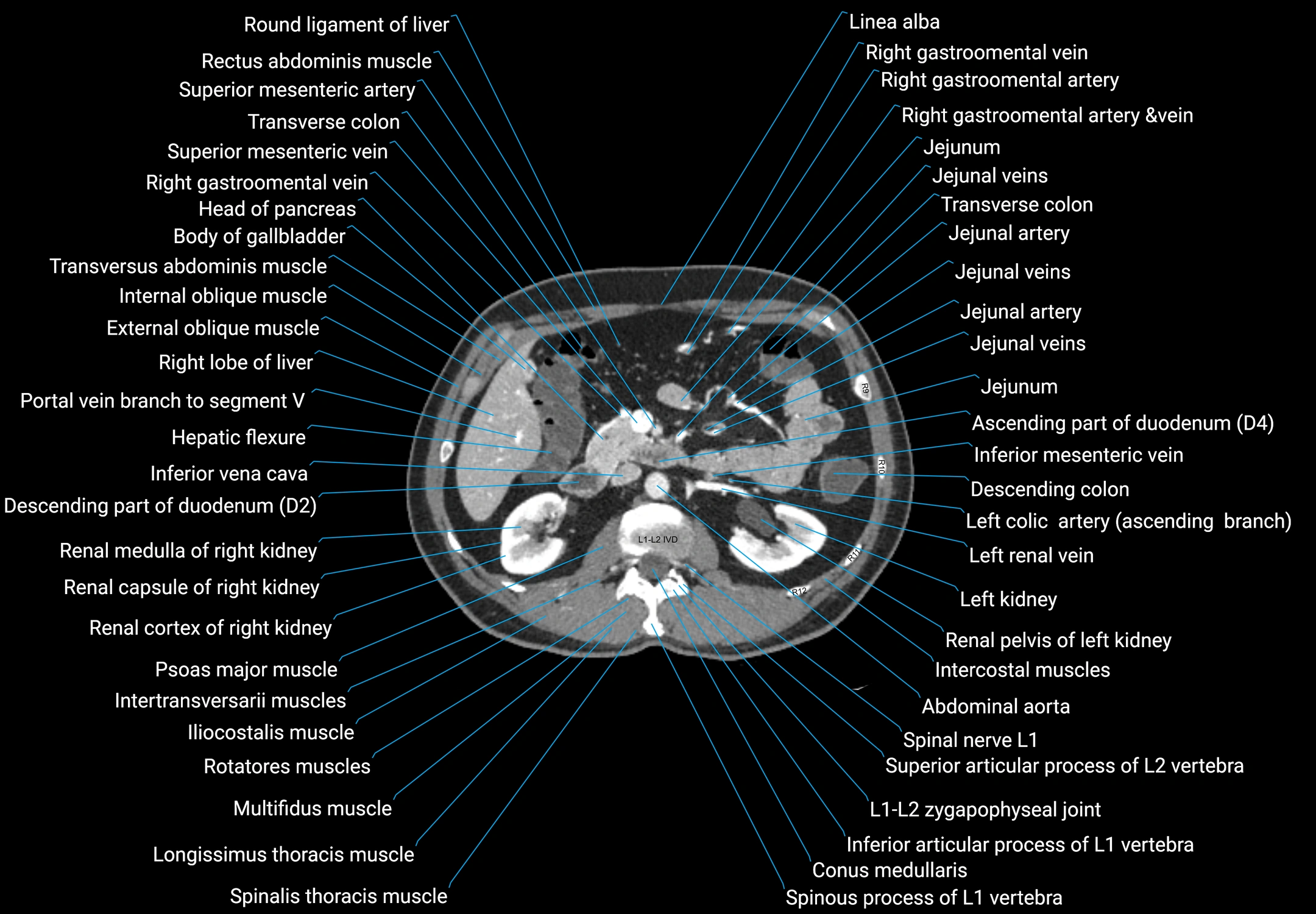 CT male pelvis axial cross sectional anatomy labelled radiology image -00067.webp